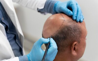 Hair Transplant and Laser Therapy: A Powerful Combination for Lasting Results