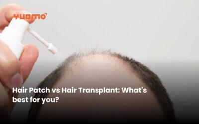 Hair patch vs Hair transplant: What is best for you?