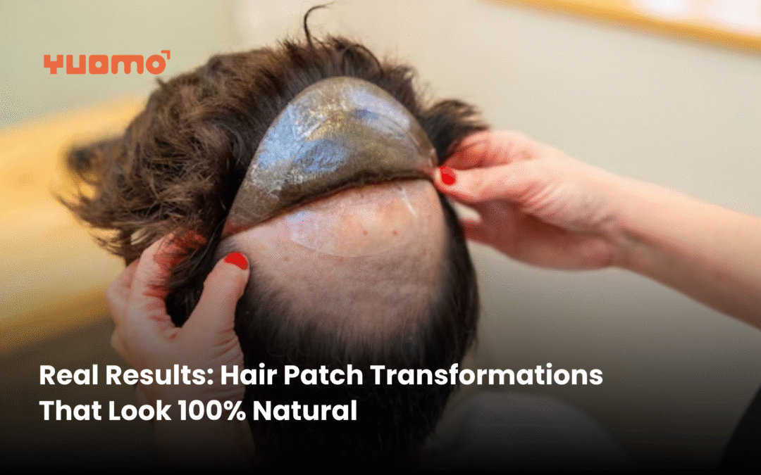 Real Results: Hair Patch Transformations That Look 100% Natural
