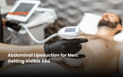 Abdominal Liposuction for Men: Getting Visible Abs