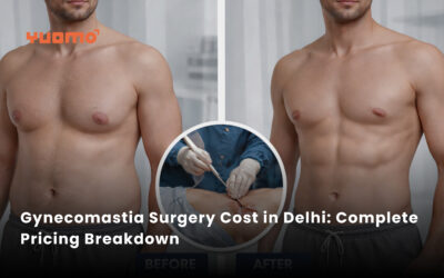 Gynecomastia Surgery Cost in Delhi: Complete Pricing Breakdown